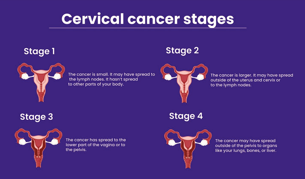cervical_cancer_stages